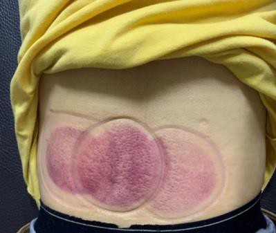 下背痛實例個案報告3