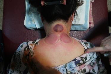 成人感染新冠25