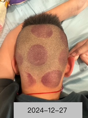 小朋友頭部創傷3