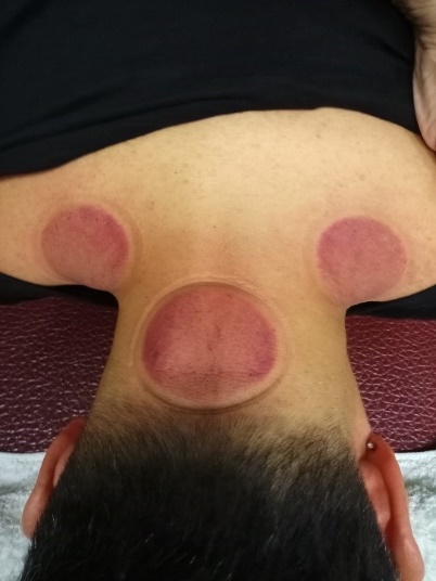 無症狀長新冠病患5