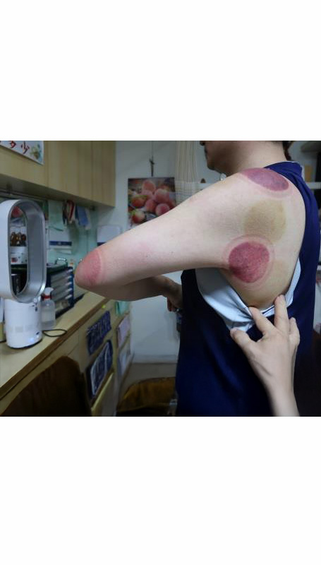 肩臂上肢疼痛IIv1